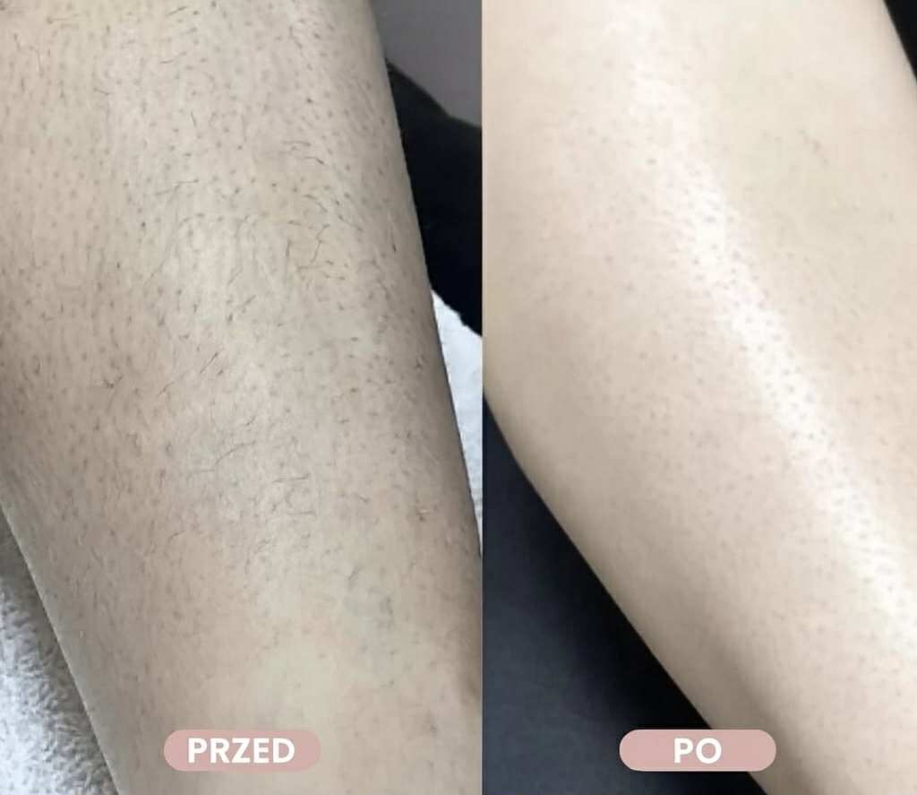 Trimella - Golarka do ciała